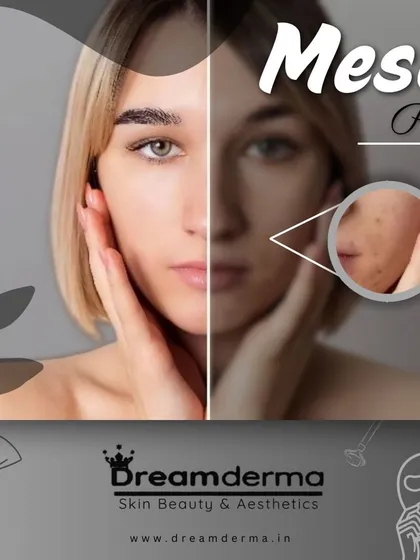 Our Meso Peel is a chemical peel that targets skin concerns at a deeper level. It is excellent for lightening dark spots, stimulating collagen, smoothing fine lines, and reducing acne for a truly transformed complexion.