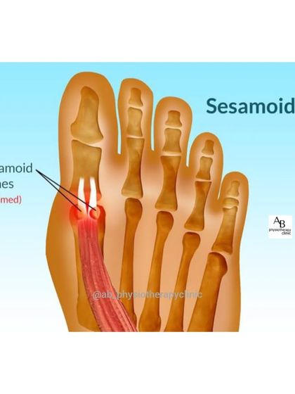 Sesamoiditis is an inflammation of the small bones under the big toe, common in runners and walkers. We treat it by addressing the inflammation and correcting foot mechanics.