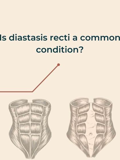 Is Diastasis Recti a common condition? This slide addresses how frequently it occurs in postpartum women.
