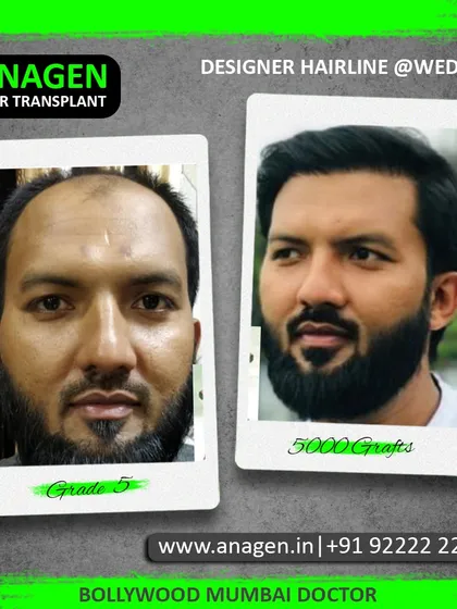 A designer hairline for a wedding. This patient with Grade 5 baldness received 5000 grafts, resulting in a stylish and full beard and hairline combination.