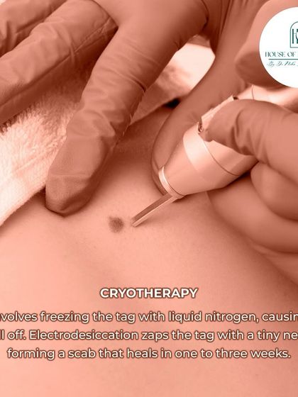We use Cryotherapy, which involves freezing the tag with liquid nitrogen, causing it to fall off naturally. Another option is Electrodesiccation, which zaps the tag with a tiny needle, forming a scab that heals within a few weeks.