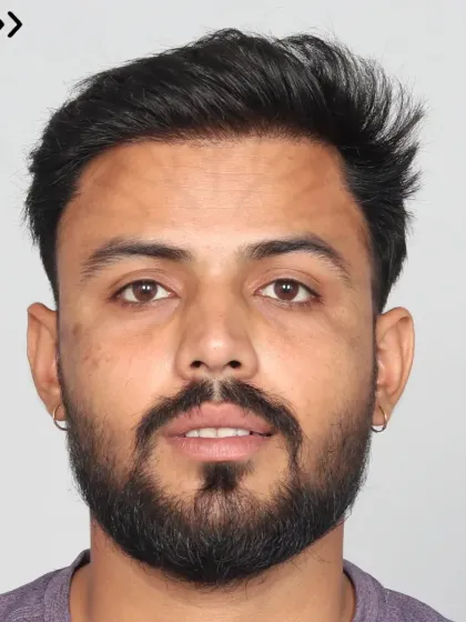 A stunning 12-month transformation for a Grade 3 baldness case. We used 3000 grafts for a personalized hairline, temple reconstruction, and dense frontal coverage.