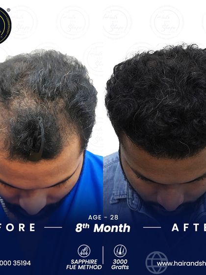This image shows the impressive density and coverage achieved just 8 months after the procedure, effectively addressing the patient's hair thinning concerns.