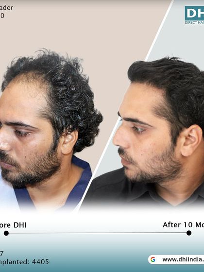 Another side-profile view of the 10-month result. This angle highlights the seamless flow and density from front to back, a testament to the meticulous work of our doctor-led team.