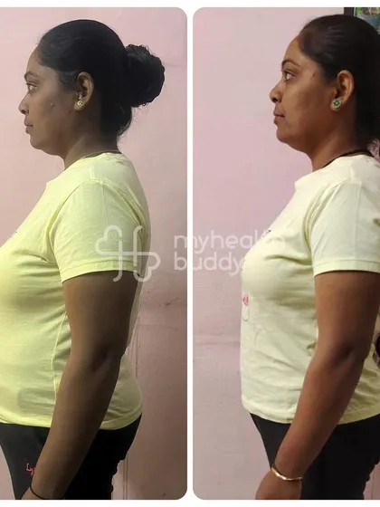 Another side view of Rekha's transformation, highlighting her consistent progress over three months.