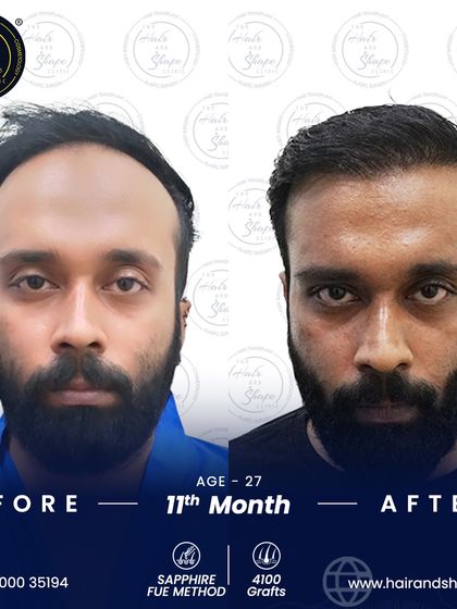 At 11 months post-op, this patient's 4100-graft Sapphire FUE transplant has completely transformed his appearance, restoring a strong, natural hairline.