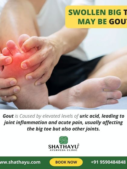 Gout is caused by elevated uric acid levels that lead to joint inflammation and acute pain, most commonly in the big toe. My treatments focus on reducing uric acid and managing the inflammation.