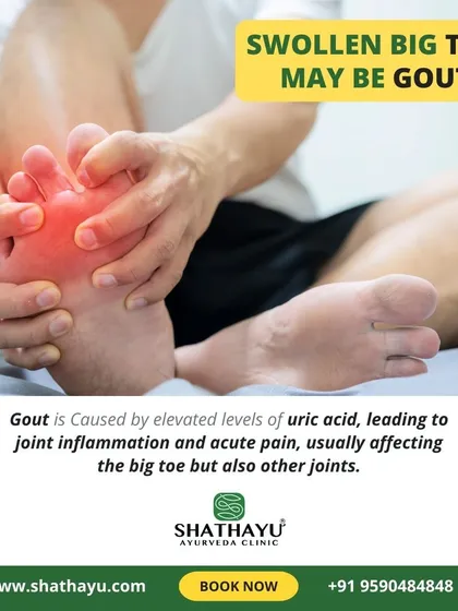 A swollen big toe can be a sign of Gout, which is caused by high uric acid levels. I offer effective Ayurvedic therapies to treat the joint inflammation and acute pain associated with this condition.