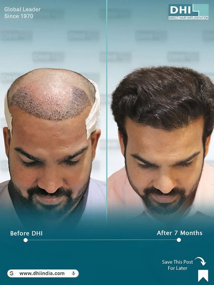 This image shows the client's head immediately after the procedure alongside the 7-month result. It provides a transparent look at the healing process and the incredible growth achieved with our DHI technique.