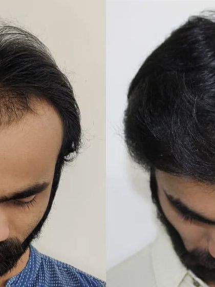 This top-down view shows the impressive density we achieved, covering the previously thinning areas completely.