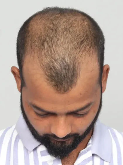 This 13-month result for a Grade 6 baldness case shows what's possible with 6300 grafts. We restored his hair, style, and youthful appearance.