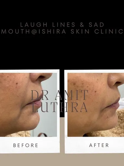Dermal fillers are highly effective for softening laugh lines (nasolabial folds) and lifting a "sad mouth" (marionette lines). This treatment provides a subtle lift that makes a significant difference.