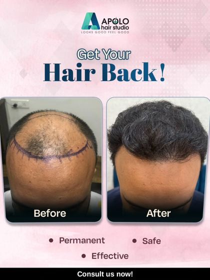 Getting your hair back should be a safe and effective process. This transformation highlights how we address significant balding to deliver permanent, natural results that you can count on.