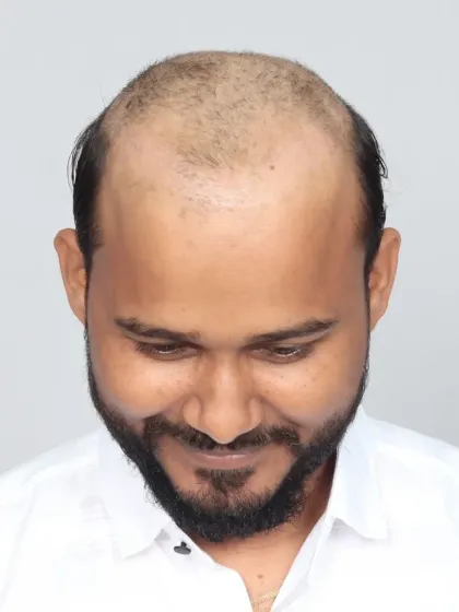 A remarkable 9-month transformation. We used 5000 grafts for hairline restoration and mid-scalp coverage, resulting in visible volume and confidence.