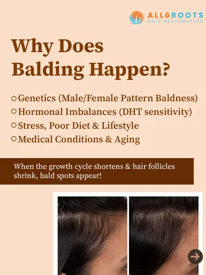 Understanding why balding occurs is the first step to treating it. This visual breaks down the primary causes I diagnose in my clinic, including genetic predispositions like male or female pattern baldness, hormonal imbalances related to DHT, and lifestyle factors. A correct diagnosis is critical for an effective treatment plan.