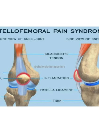 Patellofemoral Pain Syndrome, or "runner's knee," causes pain in the front of the knee. It's often due to muscle imbalances or overuse, which we address with targeted therapy.
