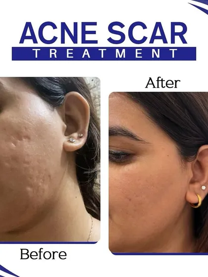 This before and after image is a powerful example of our acne scar treatment. We focus on significantly improving skin texture and reducing the depth of scars to restore smooth skin and confidence.