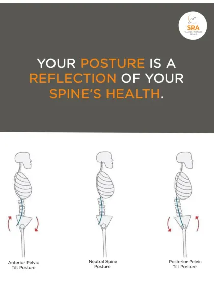 Your posture is a direct reflection of your spine's health. This graphic illustrates different pelvic tilts and how a neutral spine reduces strain and prevents long-term issues.