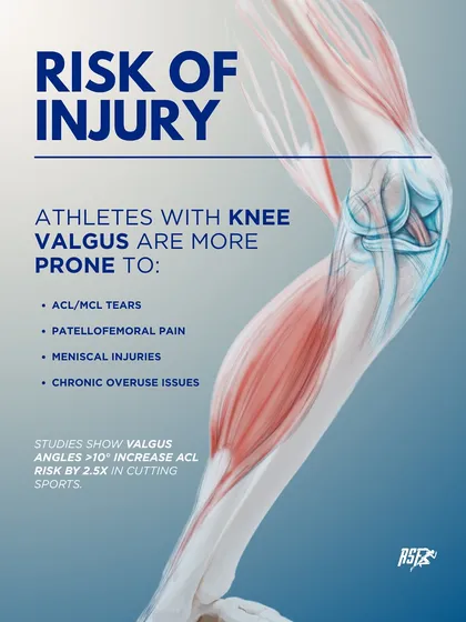 The Risk of Injury from Knee Valgus. Athletes with this pattern are more prone to ACL tears, patellofemoral pain, and meniscal injuries. This graphic highlights the serious consequences of not addressing the issue.