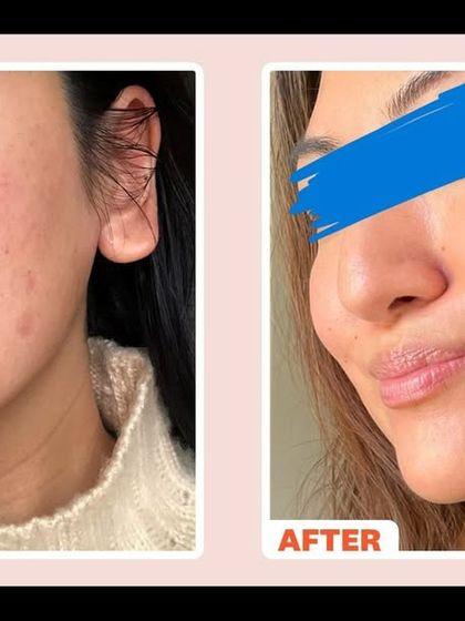 This patient's journey with MNRF shows a remarkable improvement in skin clarity and tone. This treatment is a gold standard for tackling both acne scars and general skin dullness.