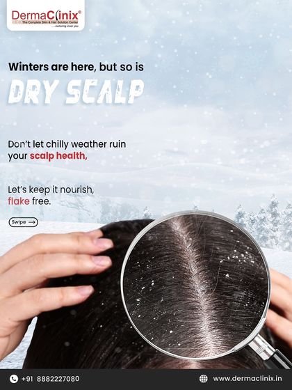 Winters are here, and so is dry scalp. This post introduces our series on how to keep your scalp nourished and flake-free during the chilly weather.