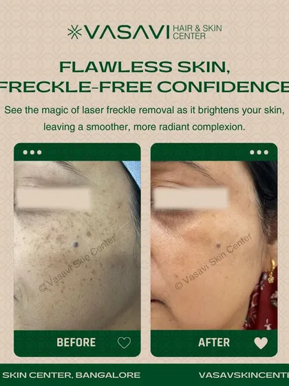 This before and after comparison demonstrates the successful removal of freckles using a targeted laser treatment. The procedure effectively lightened the dense clusters of freckles on the patient's face, resulting in a clearer and more uniform complexion.
