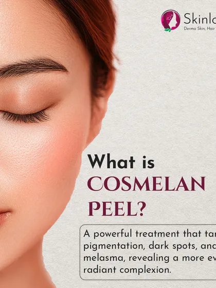 What is a Cosmelan Peel? This image defines it as a powerful treatment that targets pigmentation, dark spots, and melasma to reveal a more even, radiant complexion.