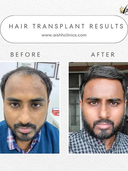 Another angle of a successful hair transplant for Grade 4-5 baldness. The after photo shows a natural-looking density and a well-defined hairline that completely changes his facial profile.