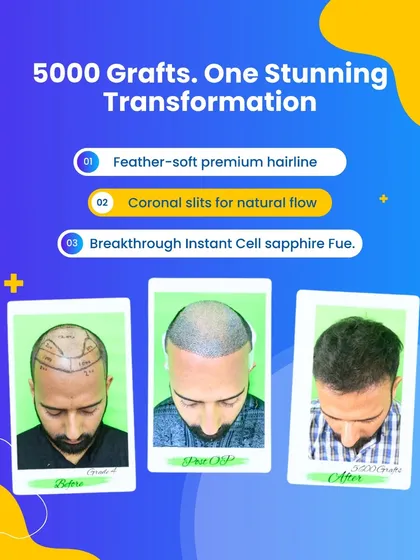 This is the complete journey from Grade 4 baldness to a full head of hair. You can see the meticulous planning before, the placement right after the procedure, and the stunning final result achieved with 5000 grafts using our Instant Cell Sapphire FUE technique.