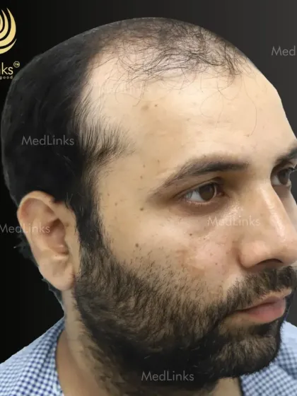 Another 'before' angle, showing the extent of the thinning from the side.