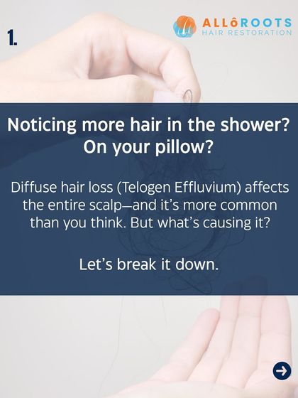 Noticing more hair on your pillow or in the shower drain? This could be Telogen Effluvium, a common form of diffuse hair loss that affects the entire scalp. Let's break down what might be causing it.