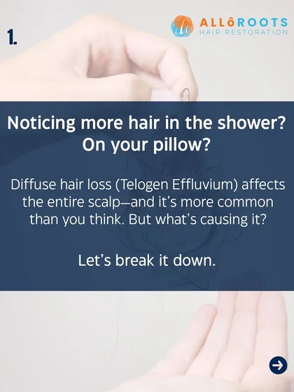 Noticing more hair on your pillow or in the shower drain? This could be Telogen Effluvium, a common form of diffuse hair loss that affects the entire scalp. Let's break down what might be causing it.