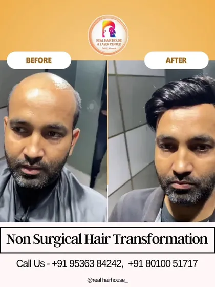 This before and after shows the power of non-surgical hair replacement. I addressed significant hair loss on the crown and hairline, resulting in a full, natural-looking head of hair.