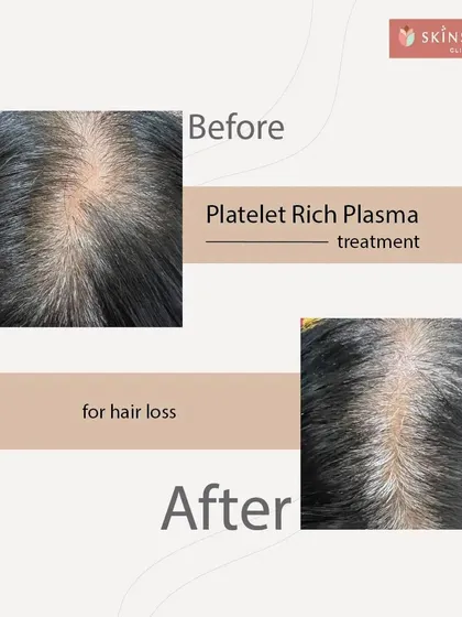 Here you can see the before and after results of a Platelet Rich Plasma (PRP) treatment. This non-surgical procedure is highly effective for tackling early-stage hair loss and thinning. Notice the significant improvement in hair density and scalp coverage, achieved by stimulating the hair follicles with the body's own healing properties.