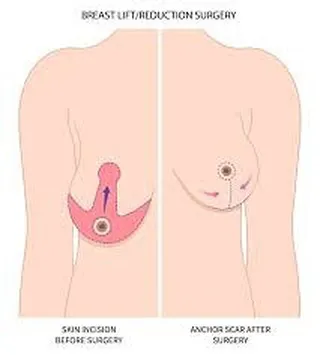 This diagram illustrates the surgical plan for a breast reduction or lift. The markings show where skin is removed to reshape and lift the breast, resulting in what is often called an "anchor scar". This procedure is planned in detail to ensure the final result is proportionate and natural-looking.