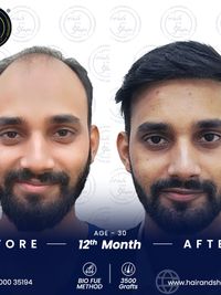 Hair Restoration