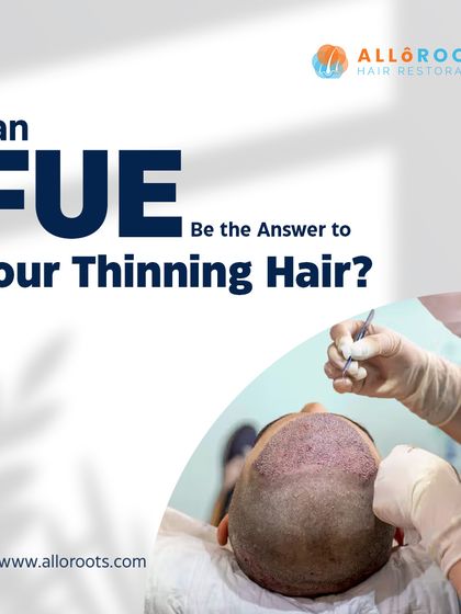 This series explains the Follicular Unit Extraction (FUE) technique. It is a minimally invasive method where I extract individual hair follicles and transplant them, resulting in minimal scarring and natural-looking, permanent hair.