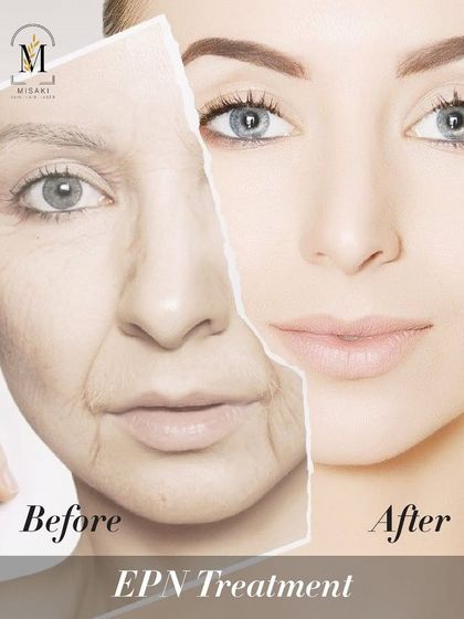 A before and after comparison showing the anti-aging effects of EPN treatment, which reduces fine lines and firms the skin.