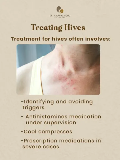 Treating hives involves a multi-pronged approach. The first step is to identify and avoid triggers. Management often includes antihistamine medication, cool compresses for symptomatic relief, and prescription medications for severe or chronic cases.