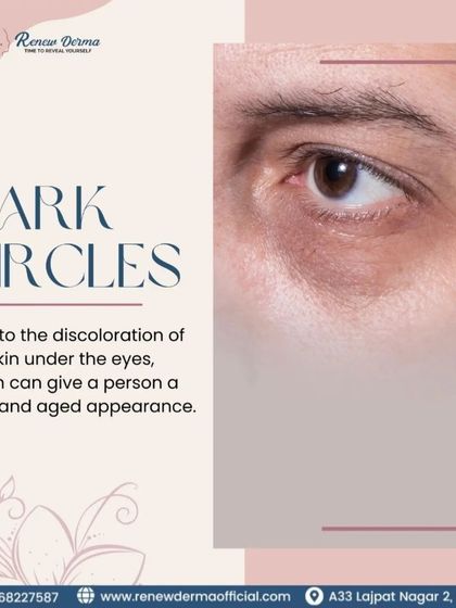 Dark circles can give a tired and aged appearance. We offer treatments to address the underlying causes and reduce the discoloration under the eyes.