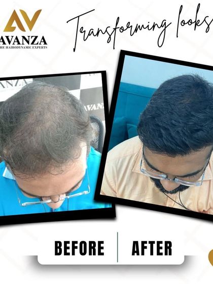 A life-transforming result. This before and after shows a complete restoration of hair, giving the client a renewed sense of confidence and well-being.