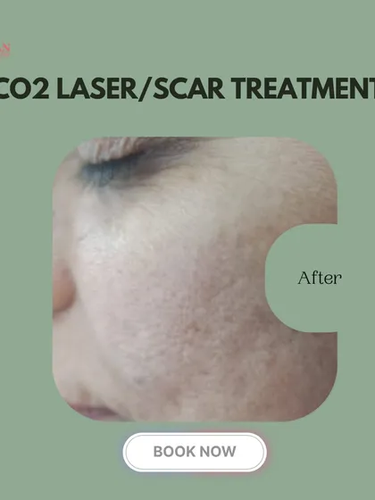 This "after" photo displays the remarkable improvement in skin texture following a CO2 laser treatment series. The scars are visibly reduced, and the skin is smoother and more even.