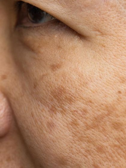 A close-up view of melasma, characterized by patchy brown discoloration. My treatments are designed to gently break down this pigment and prevent its recurrence with a maintenance plan.
