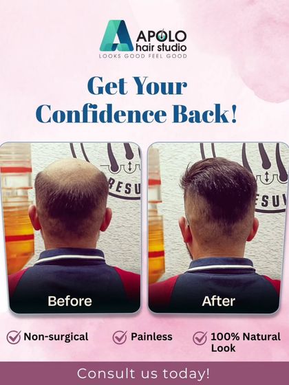 From the back, you can see the complete coverage our hair patch provides. We restored this client's look with a non-surgical, painless application that gives a 100% natural appearance, boosting his confidence instantly.