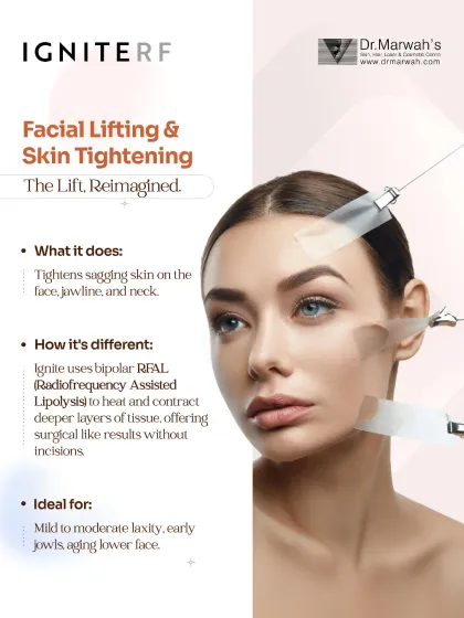 This graphic explains how Ignite RF provides a lift without surgery. It uses bipolar radiofrequency to heat and contract deeper tissue layers, tightening sagging skin on the face, jawline, and neck. It is ideal for treating mild to moderate laxity and early jowls.