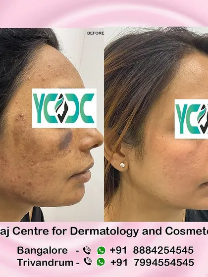 This is the powerful result of real medical care. We corrected severe skin damage and deep pigmentation for this patient, which was caused by a treatment from an unqualified practitioner. This transformation shows our commitment to restoring skin health safely and effectively.