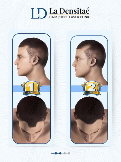 This graphic shows the first two stages of hair loss. The earlier you catch it, the better your chances of a successful comeback. It's important to take control before you enter the danger zone.