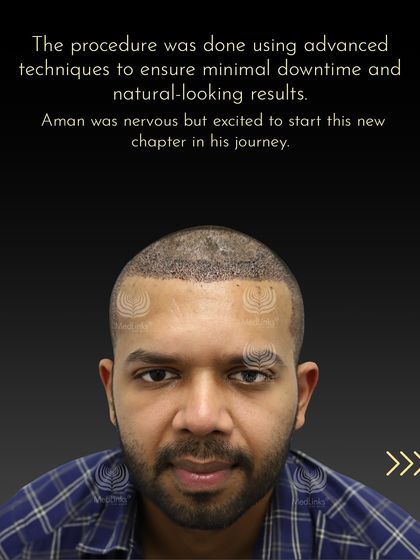 Aman immediately after the procedure, which was done using advanced techniques for minimal downtime and natural-looking results.