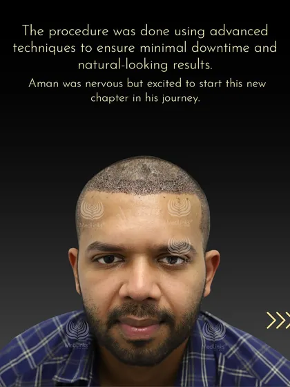 Aman immediately after the procedure, which was done using advanced techniques for minimal downtime and natural-looking results.