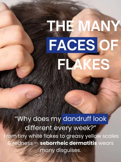 Dandruff, or seborrheic dermatitis, can present in many ways, from tiny white flakes to greasy yellow scales with redness. The appearance can change, but the underlying cause needs consistent management.